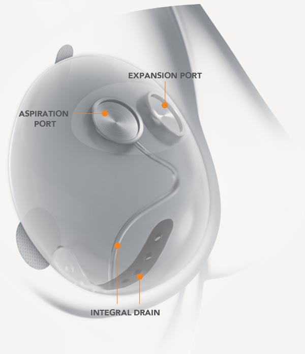 Breast Tissue Expanders in My Practice Sientra