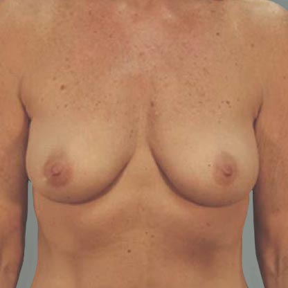 patient frontal view before low projection breast implant dr grotting