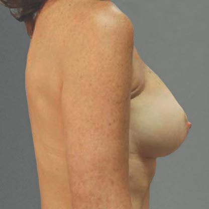 patient profile view after low projection breast implant dr grotting