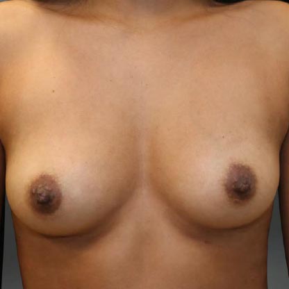 patient facing view before moderate plus projection breast implants dr waltzman