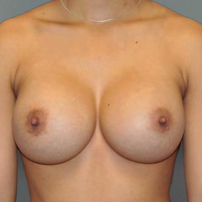 patient front view after high projection breast implants dr smith