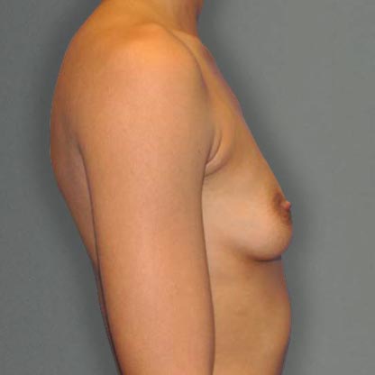 patient profile view before high projection breast implants dr smith