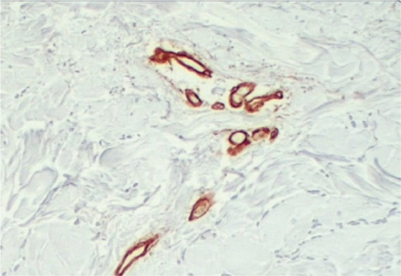 Preserved vascular channels (baseline)